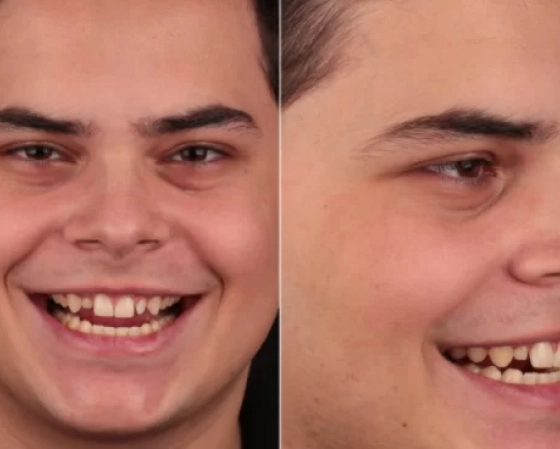 Lentes de contato 2