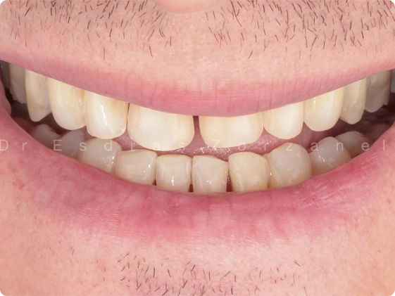 10 lentes de contato 1
