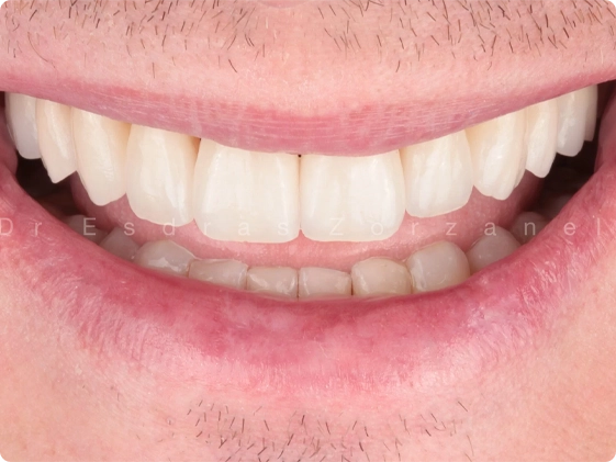 10 lentes de contato 2
