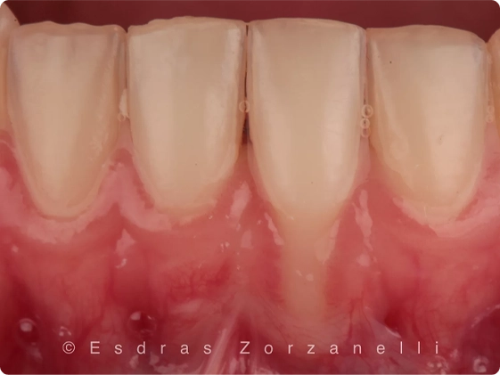 Cirurgia Plastica Gengival 1