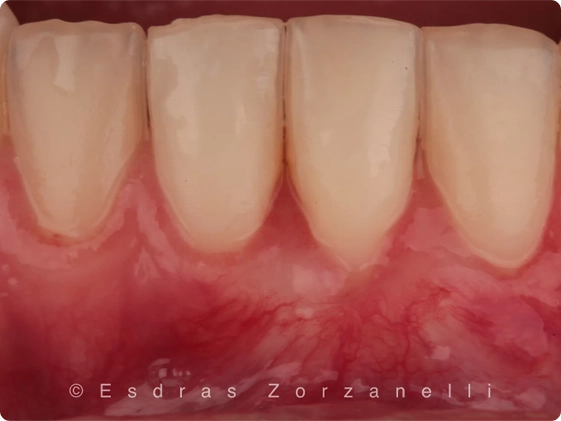 Cirurgia Plastica Gengival 2