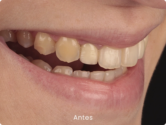 Lentes caso 1 2 antes