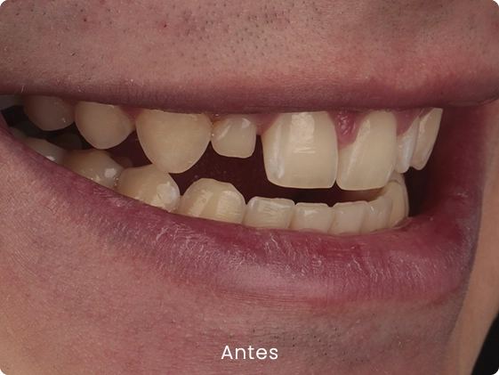Lentes caso 2 2 antes