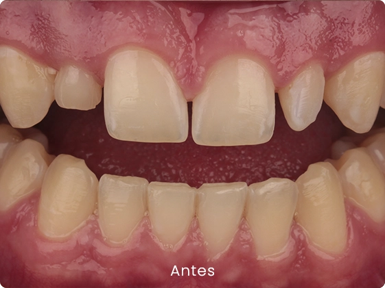 Lentes caso 2 3 antes