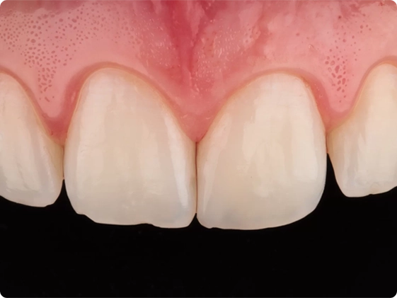 Troca de 1 Restauração Estética 1