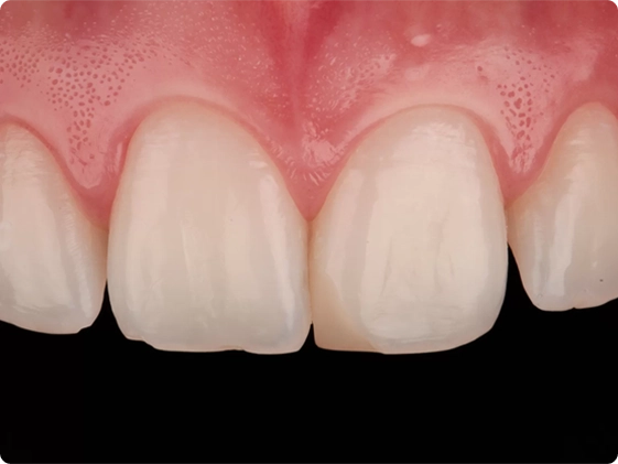 Troca de 1 Restauração Estética 2